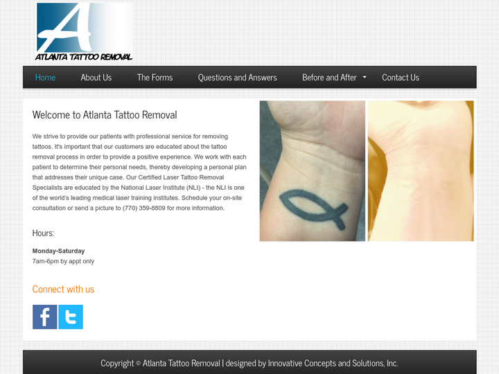 Atlanta Tattoo Removal